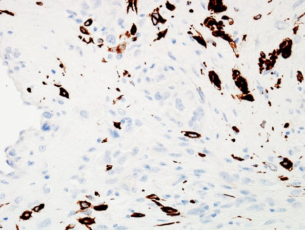 11B1 Gliosarcoma-PNET-Adenoid var (Case 11) GFAP label D2