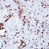 11B2 Gliosarcoma-PNET-Adenoid var (Case 11) GFAP label A