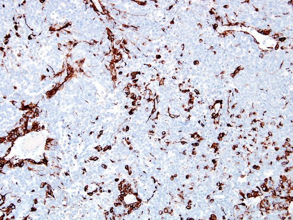 11B2 Gliosarcoma-PNET-Adenoid var (Case 11) GFAP label A