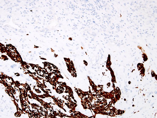 11B3 Gliosarcoma-PNET-Adenoid var (Case 11) GFAP label D1