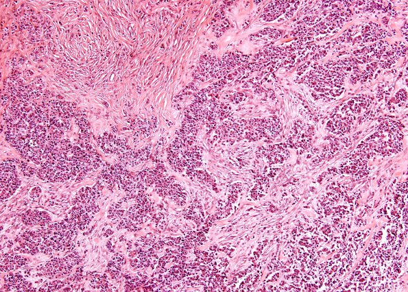 12A1 GBM, Adenoid Features (Case 12)  H&E 6