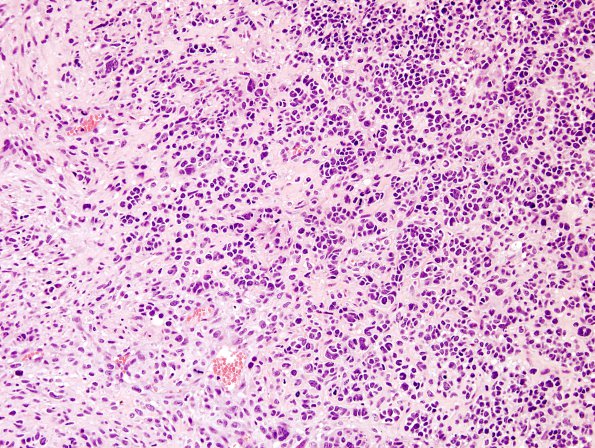 12A2 GBM, Adenoid Features (Case 12)  H&E 3