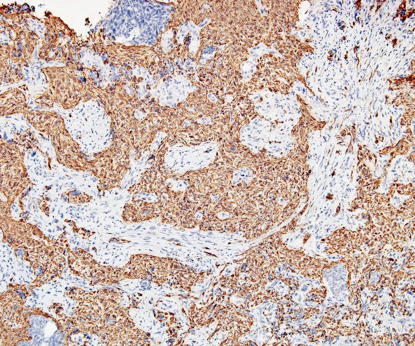 12B1 GBM, adenoid features (Case 12) GFAP 7