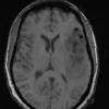 13A1 Gliosarcoma, adenoid (Case 13) T1 - Copy