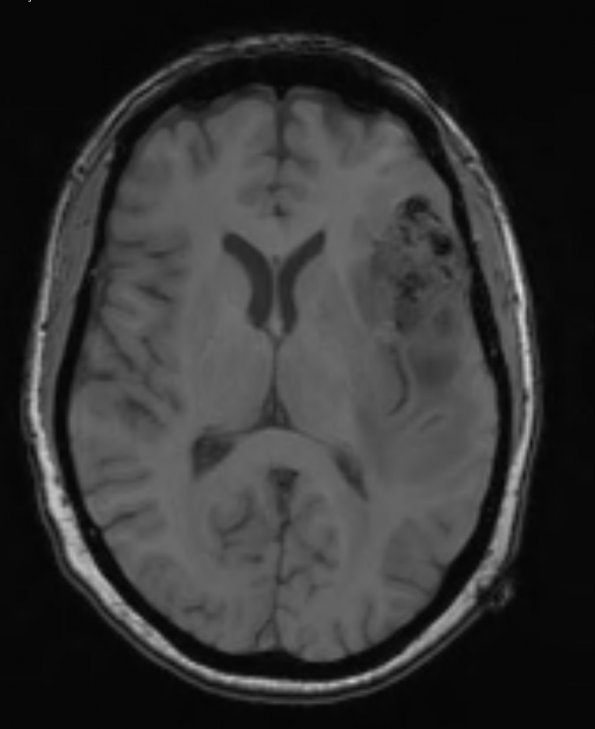 13A1 Gliosarcoma, adenoid (Case 13) T1 - Copy