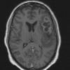 13A2 Gliosarcoma, adenoid (Case 13) T1 W - Copy