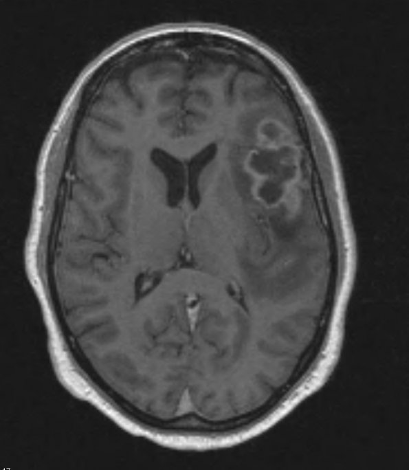 13A2 Gliosarcoma, adenoid (Case 13) T1 W - Copy