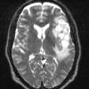 13A3 Gliosarcoma, adenoid (Case 13) T2 - Copy