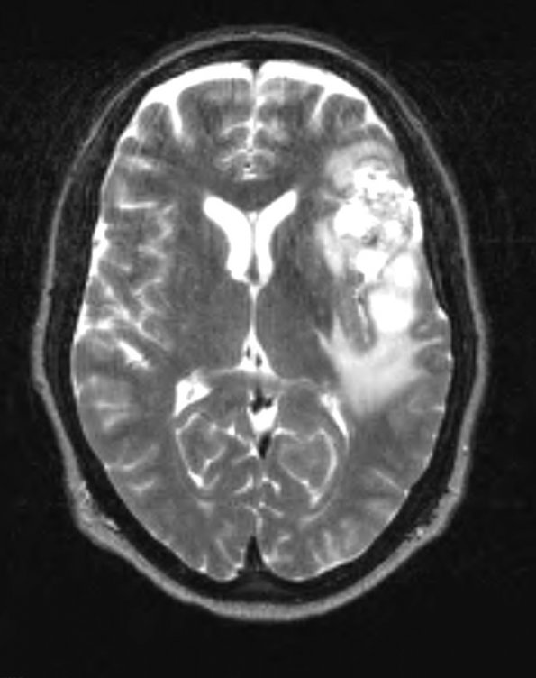 13A3 Gliosarcoma, adenoid (Case 13) T2 - Copy