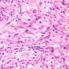 13B2 Gliosarcoma, adenoid (Case 13) H&E 1