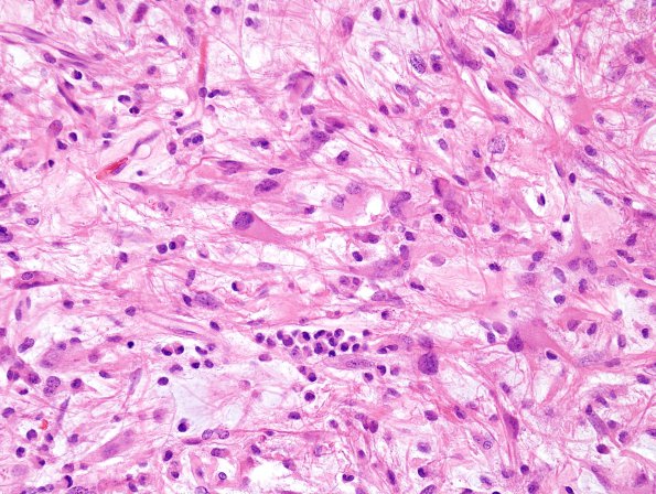 13B2 Gliosarcoma, adenoid (Case 13) H&E 1