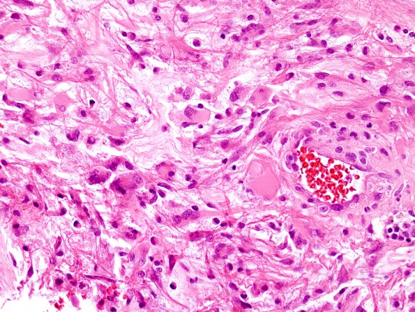 13B3 Gliosarcoma, adenoid (Case 13) H&E 9