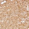 13B5 Gliosarcoma, adenoid (Case 13) GFAP 1