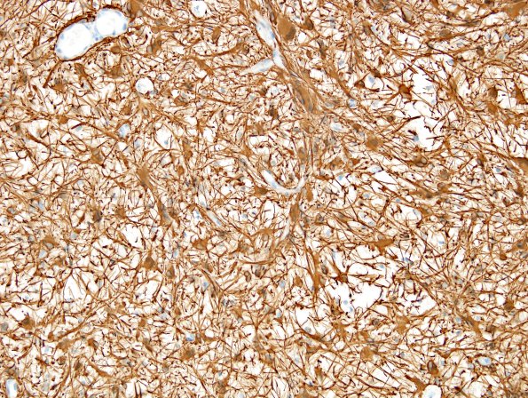 13B5 Gliosarcoma, adenoid (Case 13) GFAP 1