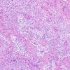 13C1 Gliosarcoma, adenoid (Case 13) H&E 14