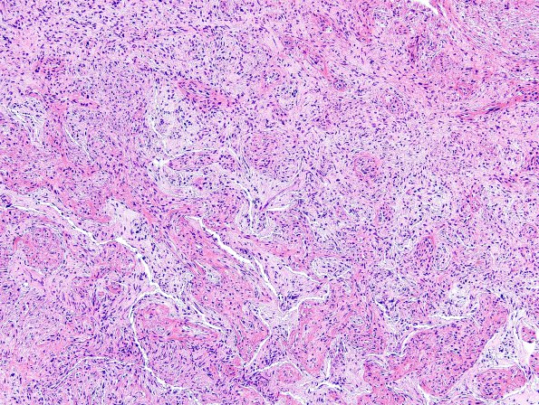 13C1 Gliosarcoma, adenoid (Case 13) H&E 14