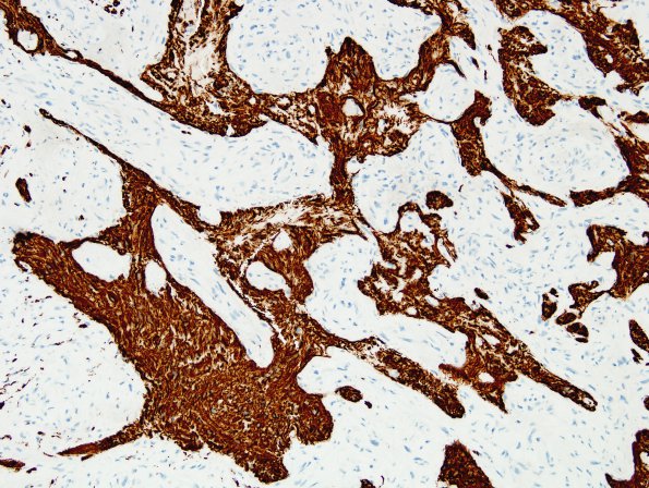 13C3 Gliosarcoma, adenoid (Case 13) GFAP 6