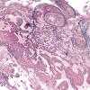 13C4 Gliosarcoma, adenoid (Case 13) Retic 7