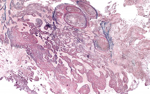 13C4 Gliosarcoma, adenoid (Case 13) Retic 7