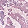 13C5 Gliosarcoma, adenoid (Case 13) Retic 20X