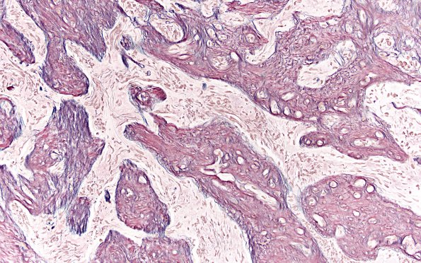 13C5 Gliosarcoma, adenoid (Case 13) Retic 20X