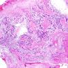 13D1 Gliosarcoma, adenoid (Case 13) H&E