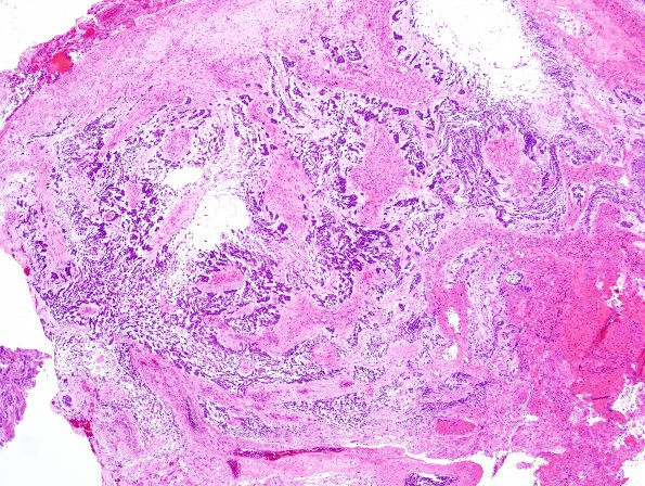 13D1 Gliosarcoma, adenoid (Case 13) H&E