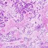 13D2 Gliosarcoma, adenoid (Case 13) H&E 6