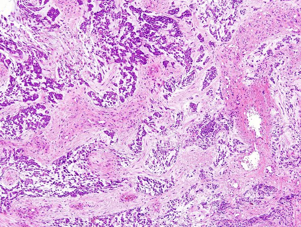 13D2 Gliosarcoma, adenoid (Case 13) H&E 6