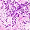 13D3 Gliosarcoma, adenoid (Case 13) H&E 7