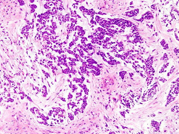 13D3 Gliosarcoma, adenoid (Case 13) H&E 7