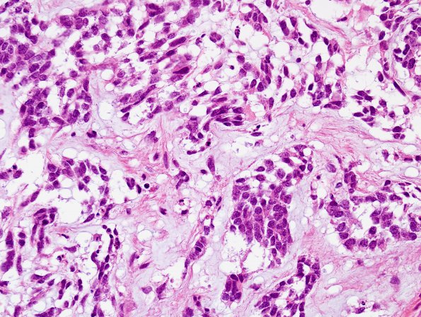 13D5 Gliosarcoma, adenoid (Case 13) H&E 15