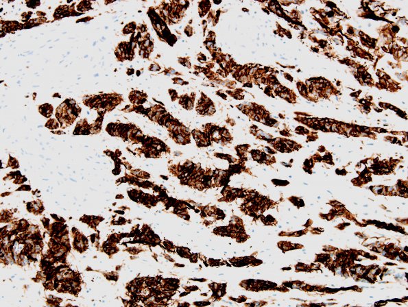 13D7 Gliosarcoma, adenoid (Case 13) GFAP 10