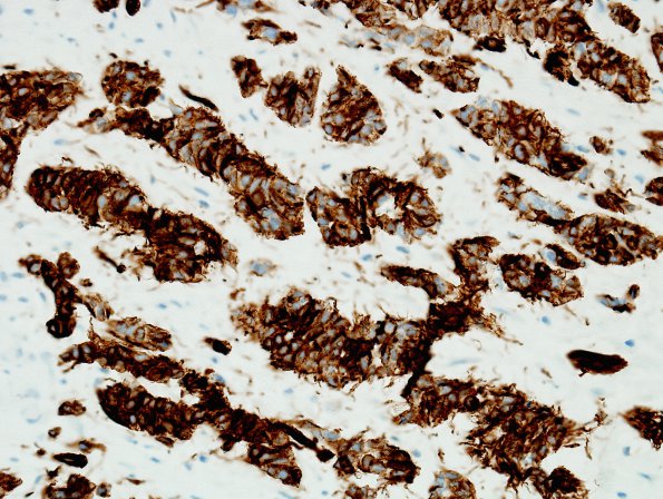 13D8 Gliosarcoma, adenoid (Case 13) GFAP 9