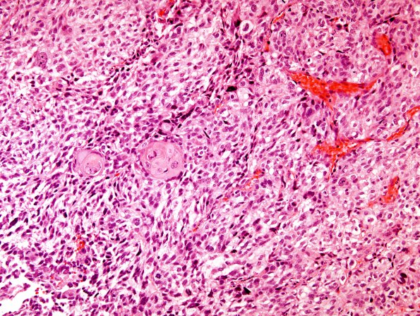 14A1 GBM, adenoid features with pearls (Case 14) H&E 2