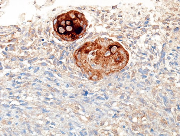 14C2 GBM, adenoid features with pearls (Case 14) Cytomix