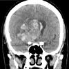 15A1 Glioblastoma, adenoid type (Case 15) CT 1 - Copy