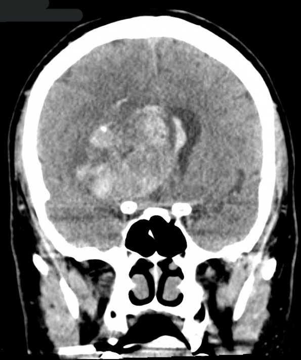 15A1 Glioblastoma, adenoid type (Case 15) CT 1 - Copy