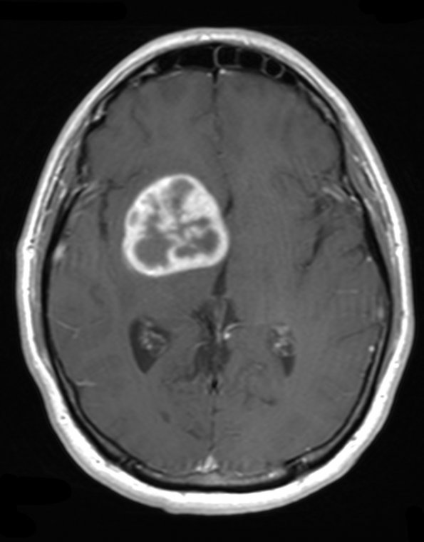 15A2 Glioblastoma, adenoid type (Case 15) T1 W - Copy