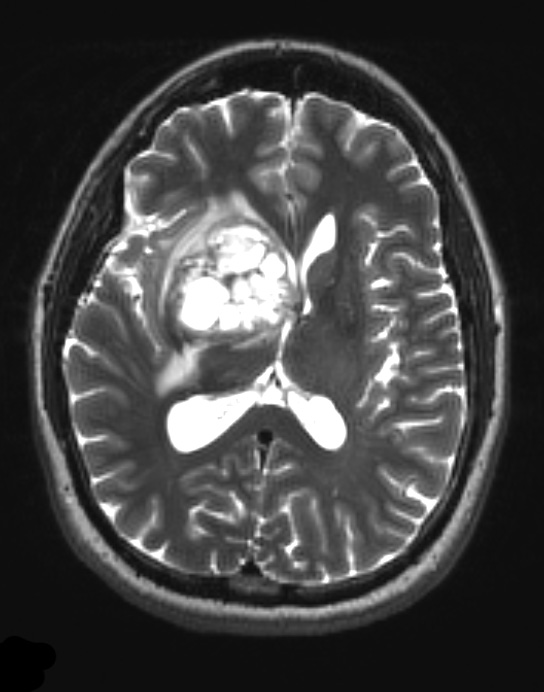 15A3 Glioblastoma, adenoid type (Case 15) T2 W - Copy