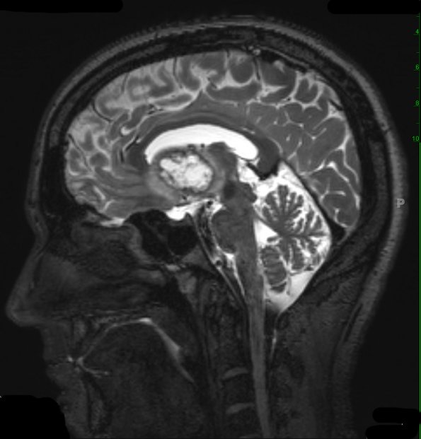 15A4 Glioblastoma, adenoid type (Case 15) T2 W 2 - Copy