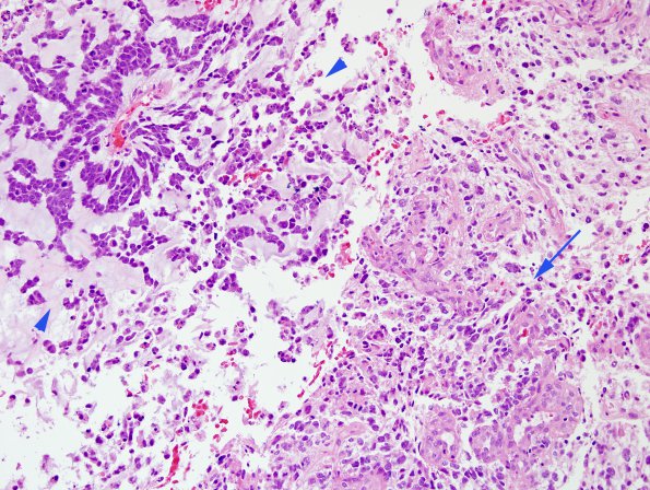 15B1 GBM, adenoid type (Case 15) area B H&E 5 copy.jpg