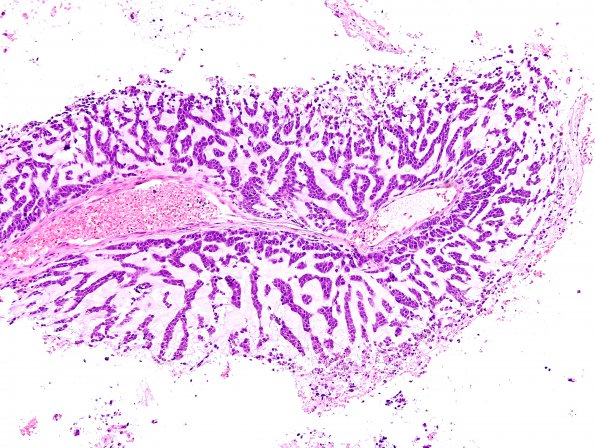 15B2 GBM, adenoid type (Case 15) H&E 14.jpg