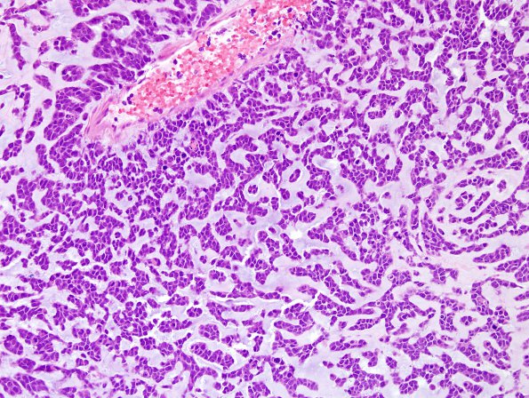 15B3 GBM, adenoid type (Case 15) H&E 9.jpg