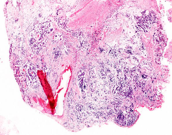 16A1 Glioblastoma, adenoid (Case 16) H&E 4X