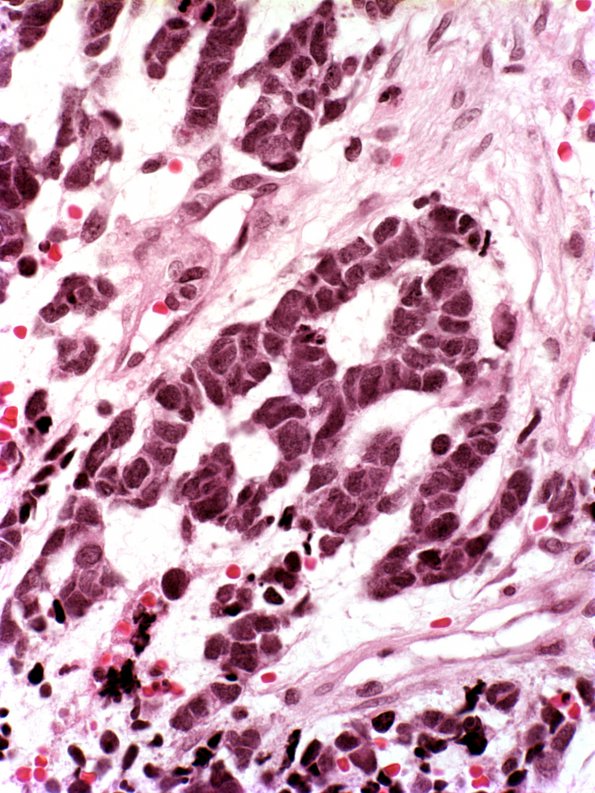 16A4 Glioblastoma, adenoid (Case 16) 1