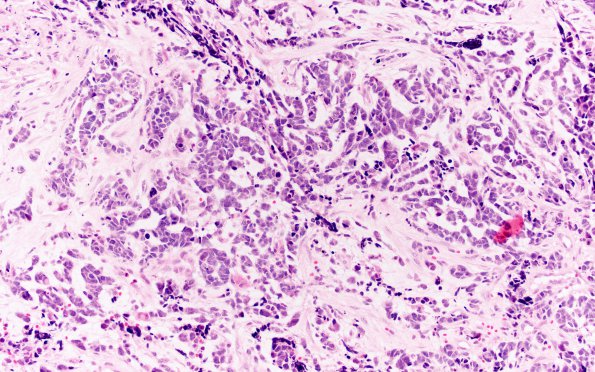 16A6 Glioblastoma, adenoid (Case 16) H&E 20X 3