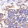 16B1 Glioblastoma, adenoid (Case 16) GFAP 20X