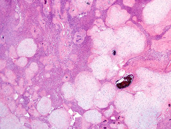 17A2 Glioblastoma, cartilage (Case 17) H&E 6.jpg