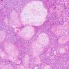 17A3 Glioblastoma, cartilage (Case 17) H&E 7.jpg